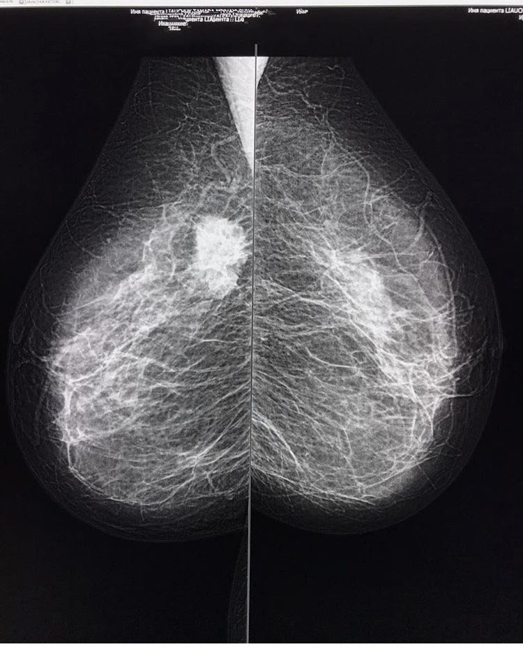 乳腺癌是什么样子的图片