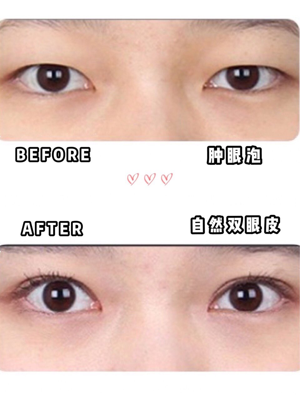 人生更高光 双眼皮到底对颜值的影响有多大呢 双眼皮的种类~ 埋线法