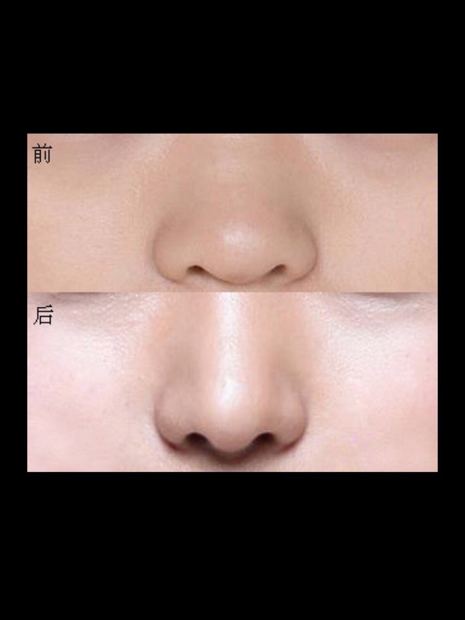 鼻翼宽怎么改善做什么手术