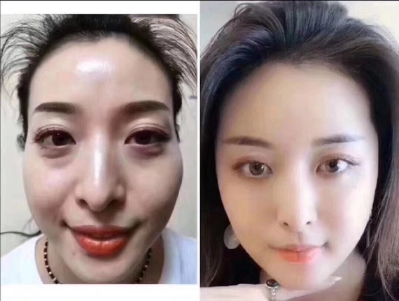 太阳穴面颊填充前后对比