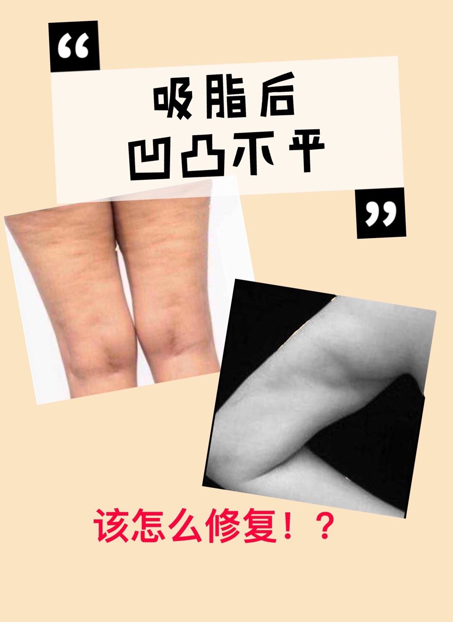 修复的求美者其中一个主要的原因就是吸脂后明显的凹凸不平线条不协调
