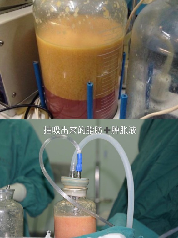 吸脂等于减肥?吸脂对身体有害吗?🍑🍑吸脂手术这几年_圈子-新氧美