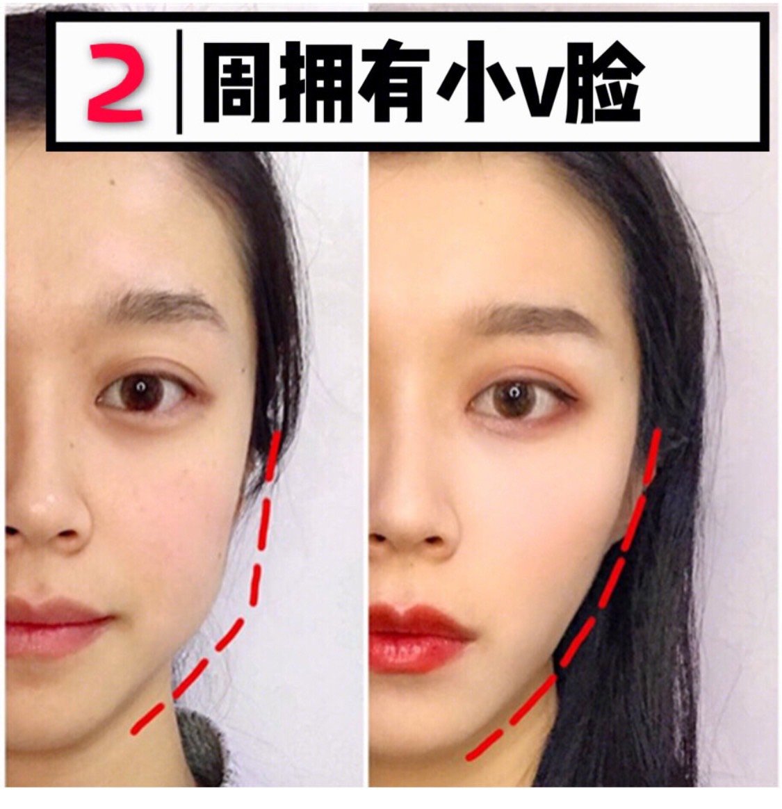 带你了解真实的肉毒素~ 除皱,瘦脸,瘦腿……肉毒素_圈子-新氧美容整形