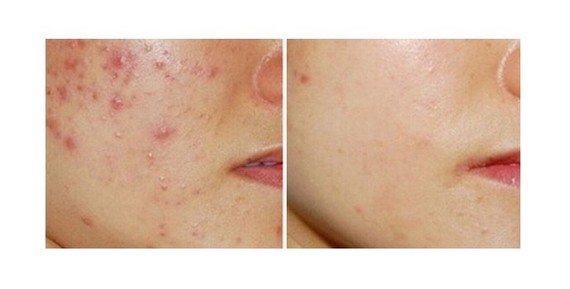 红蓝光祛痘 它有一个别名:叫 led红蓝光去痘