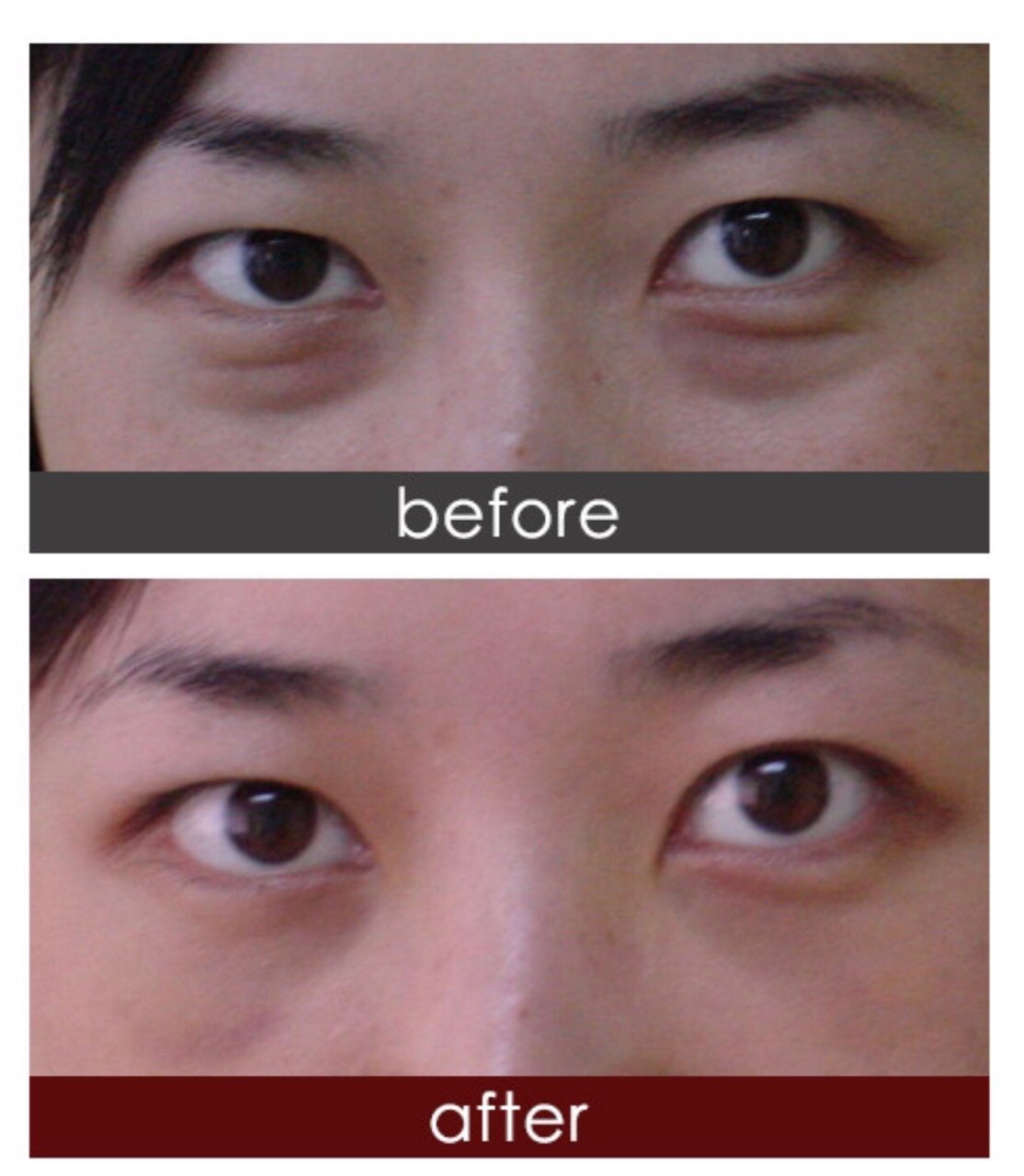 【割眼袋是一种什么样的体验?】