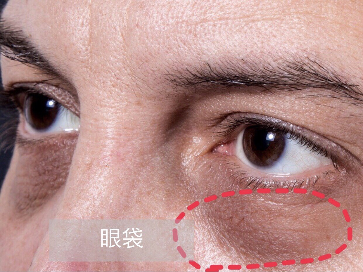【割眼袋是一种什么样的体验?】