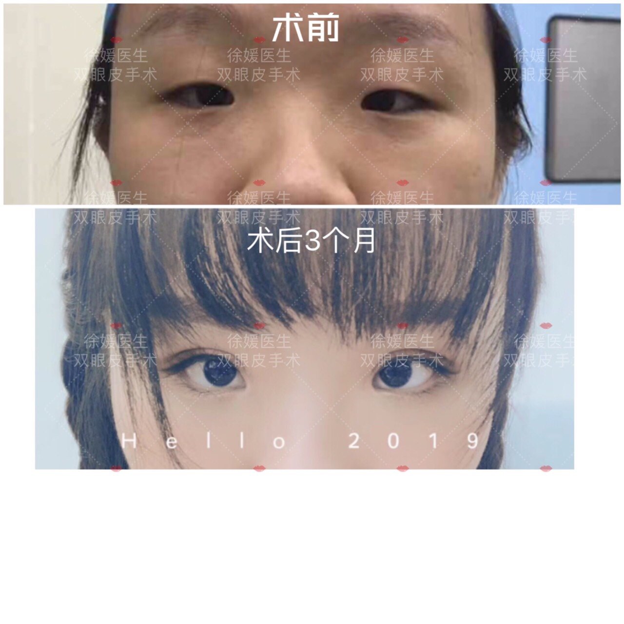 这个小姑娘时典型的〔小睑裂综合征〕小睑裂综合征表现_圈子-新氧美容