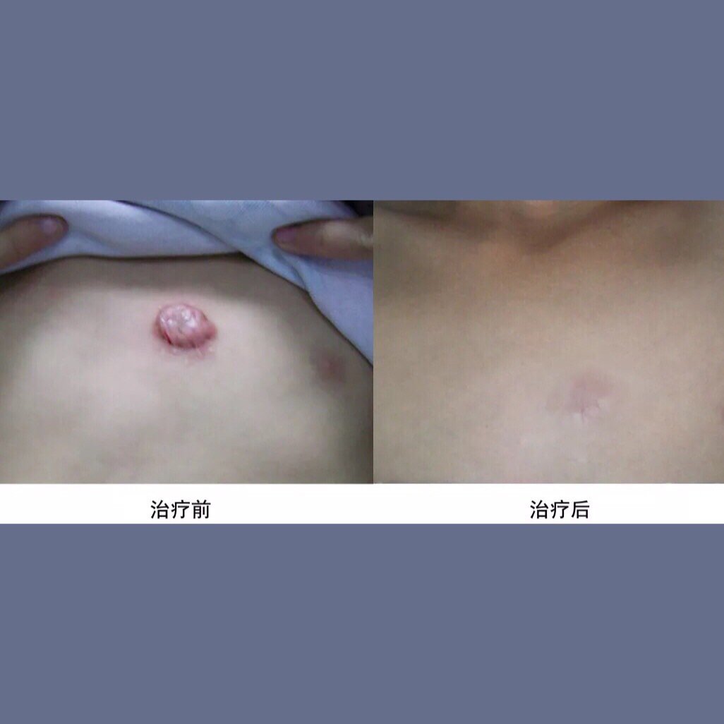 0101之前写过关于疤痕软化_圈子-新氧美容整形