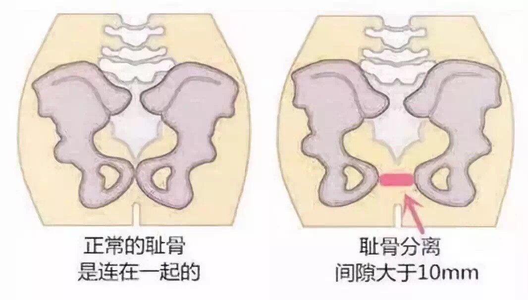 耻骨分离的症状图片