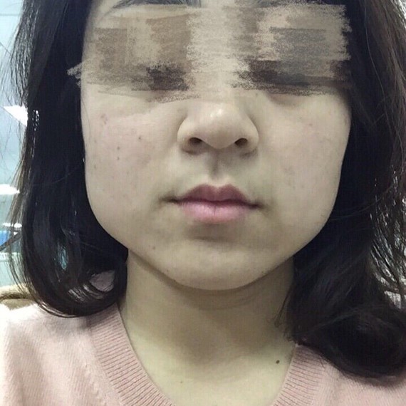 但是关于瘦脸针注射后脸部凹陷的问题,大家存在很多疑问以及到底该