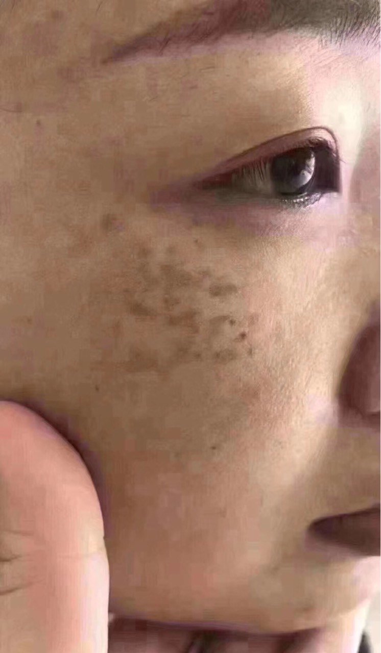 真皮斑第一期:脸颊 真皮斑第二期:太阳穴 真皮斑第