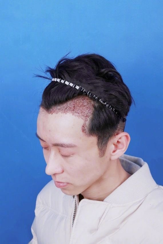 小哥哥前额m型种植的头发已经长的很自然了,额角完全_圈子-新氧美容