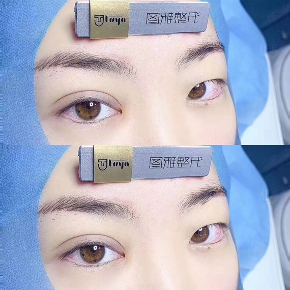 纳米无痕双眼皮,一侧刚做完的效果