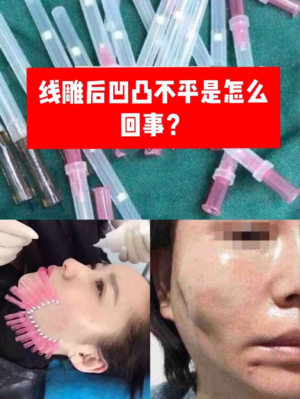 做完线雕半年了脸上凹凸不平是怎么回事