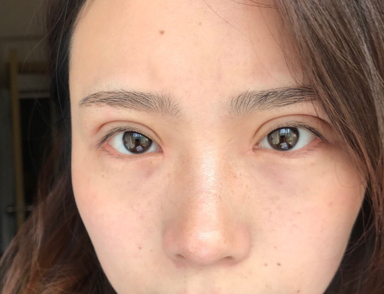 全切双眼皮77去皮去脂77开眼角 二十七天了!