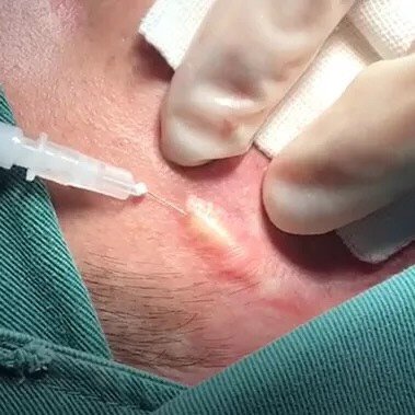 疤痕软化针到底有没有用呢?