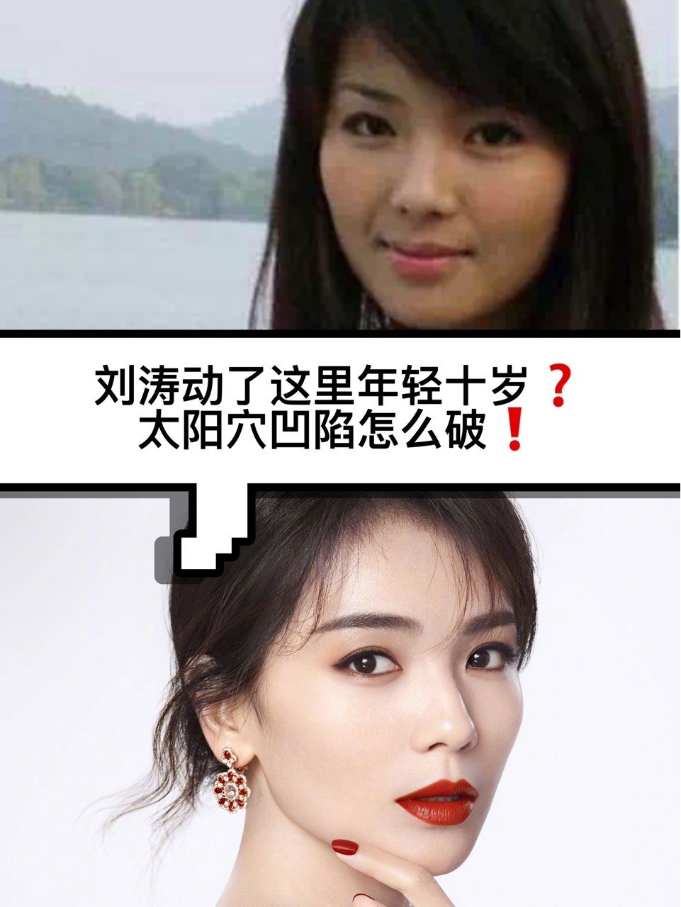 刘涛动了这里年轻十岁太阳穴凹陷怎么破