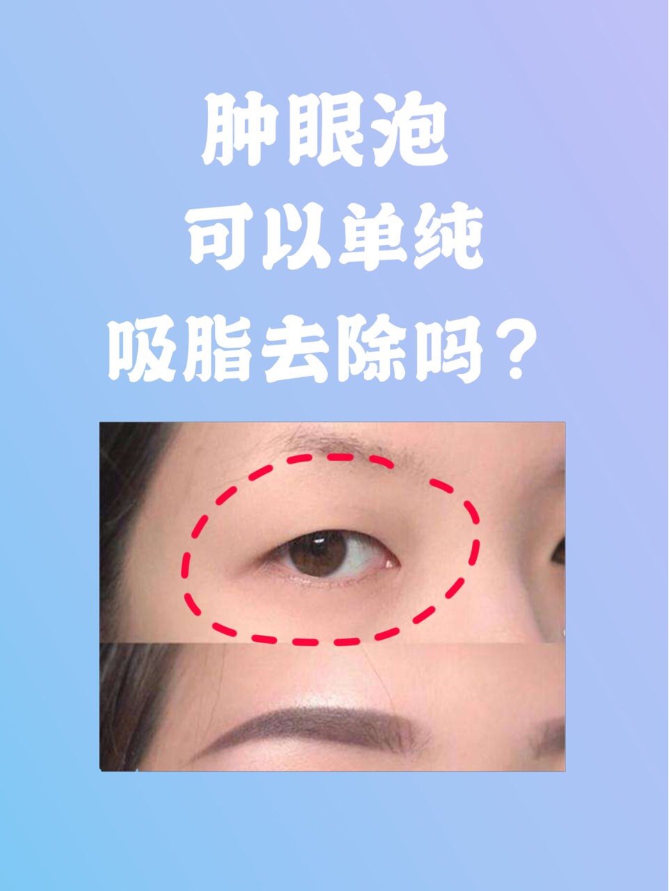 造成腫泡眼的脂肪有兩種: roof(retroorbicularis oculi fat)眼輪匝