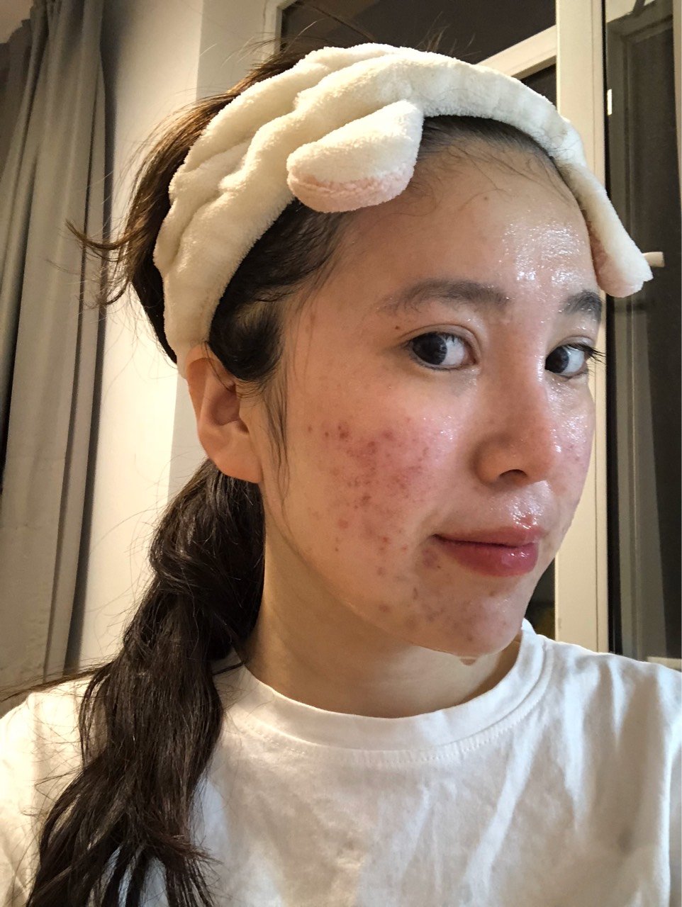 最真实的微针祛痘无滤镜美颜化妆反馈来了哦!