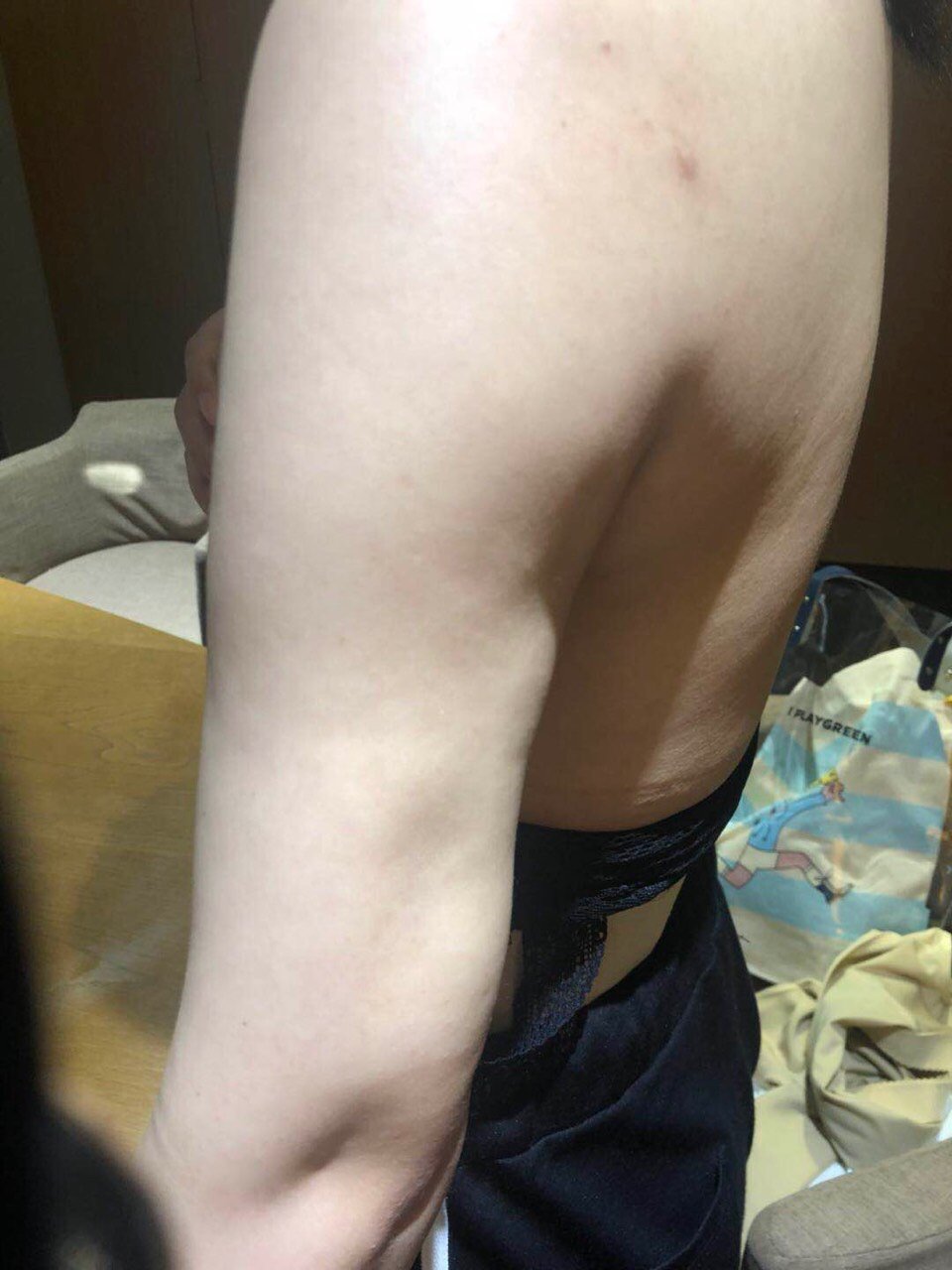 我是2018年6月19号在宁波薇琳医美做的上手臂吸_圈子-新氧美容整形