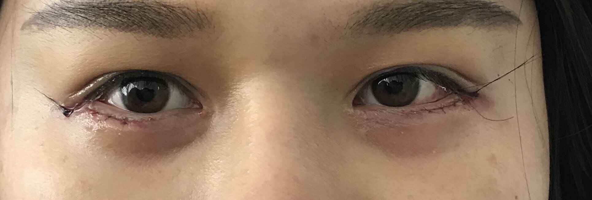 昨天在宁波华爱医美做的开外眼角加下眼眦,脂肪填充额_圈子-新氧美容