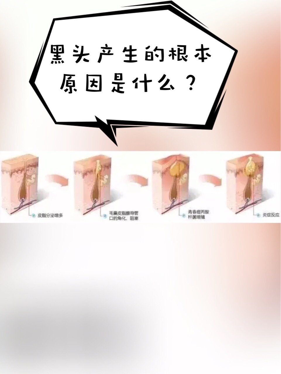 既然黑头也是痤疮的一种