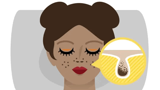 黑头产生的根本原因是? 既然黑头也是痤疮的一种,那_圈子-新氧美容整