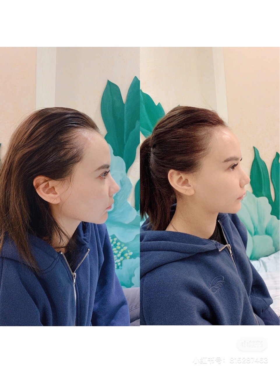 可能由于遗传的关系,发际线比较稀疏,尤其是 两边发_圈子-新氧美容