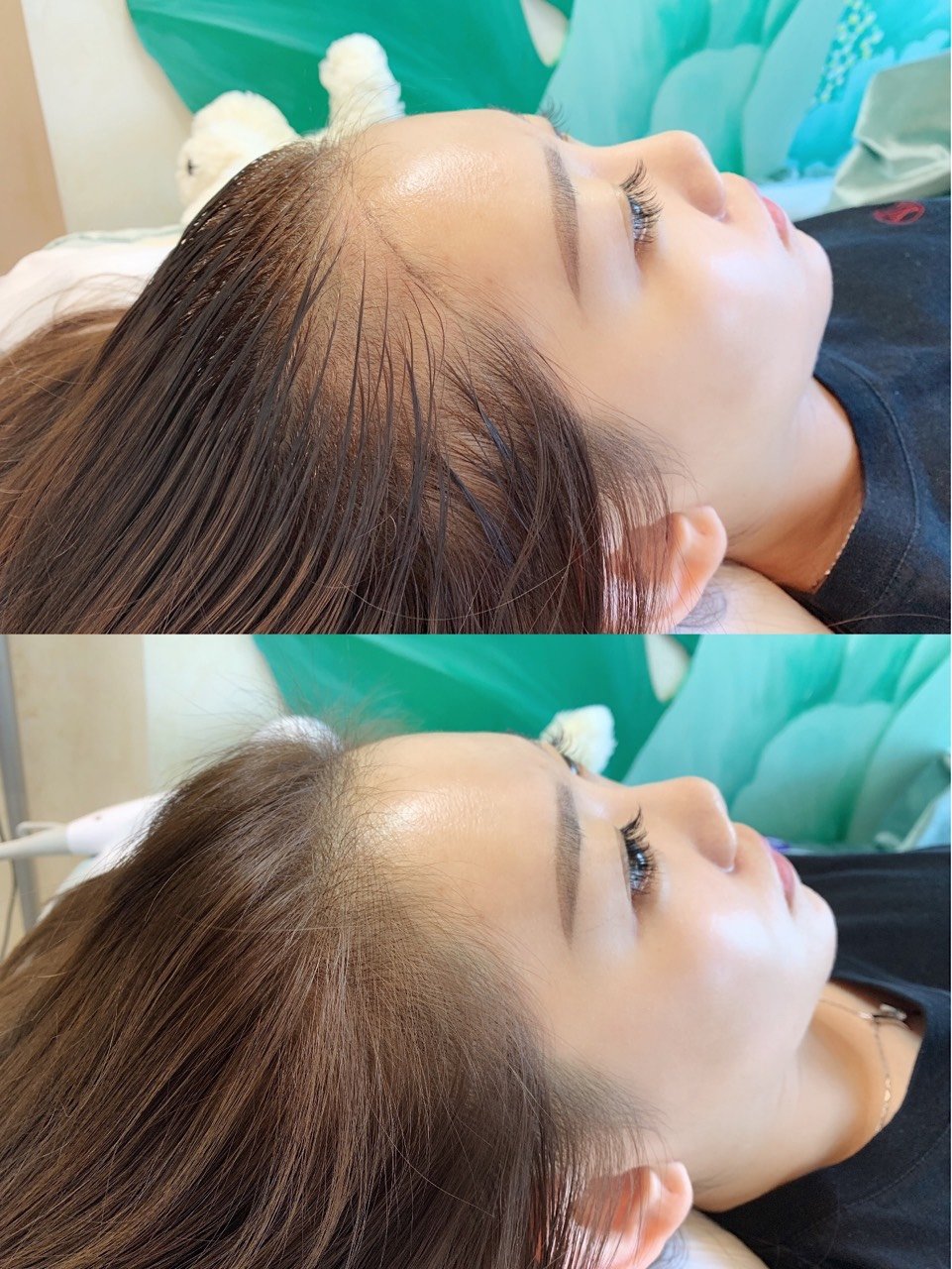 半永久发际线~我终于不秃啦