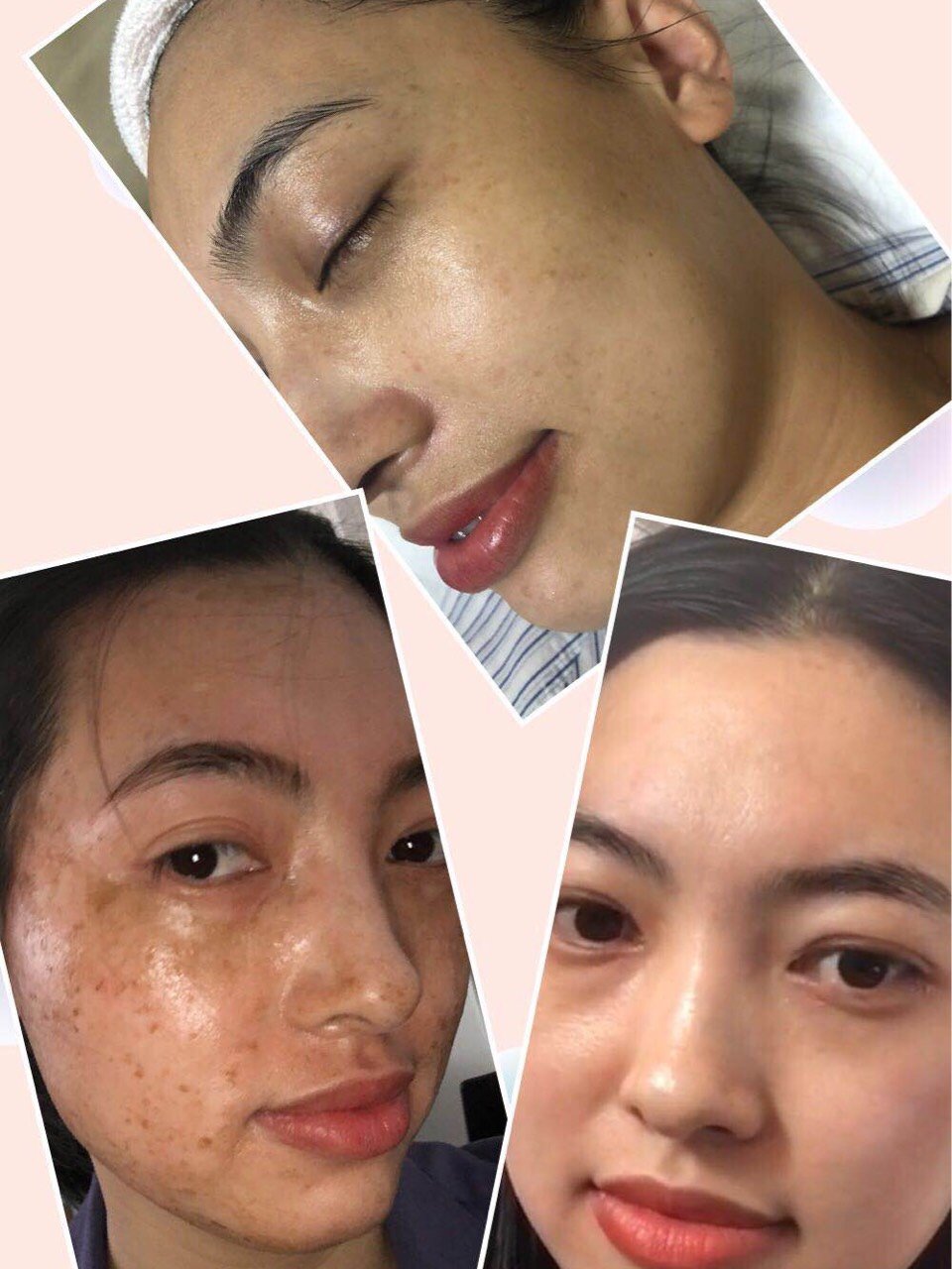 神奇的代谢式祛斑!