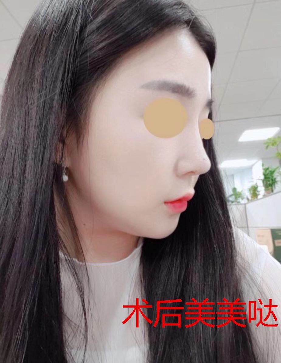 超自然的肋骨鼻术后恢复情况