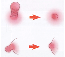 关于乳头缩小整形有哪些知识需要了解呢?