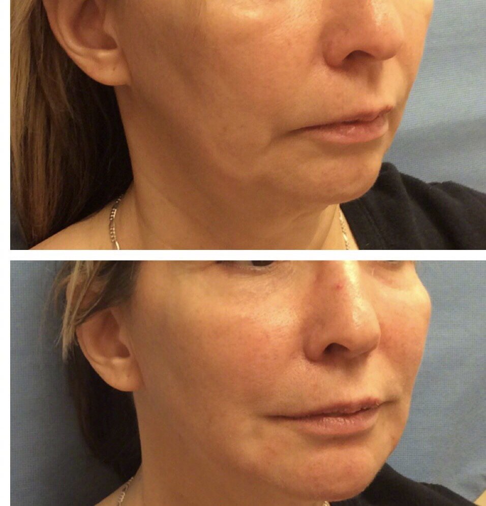 随着年纪的增长,胶原蛋白的流失会让皮肤失去支撑变得松弛下垂,导致