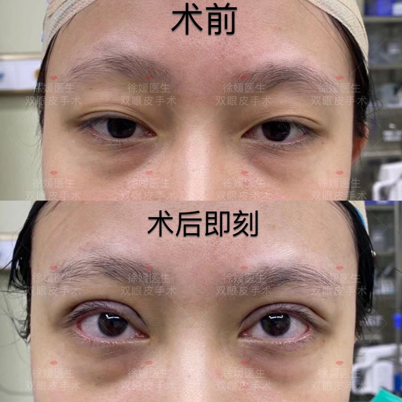 全切双眼皮77去皮去脂77提肌术后即刻