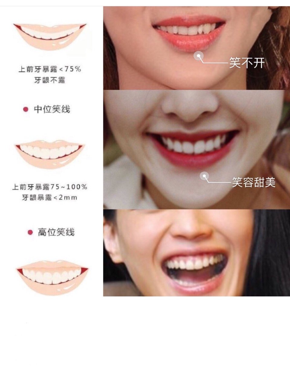 牙齿微笑线的秘密
