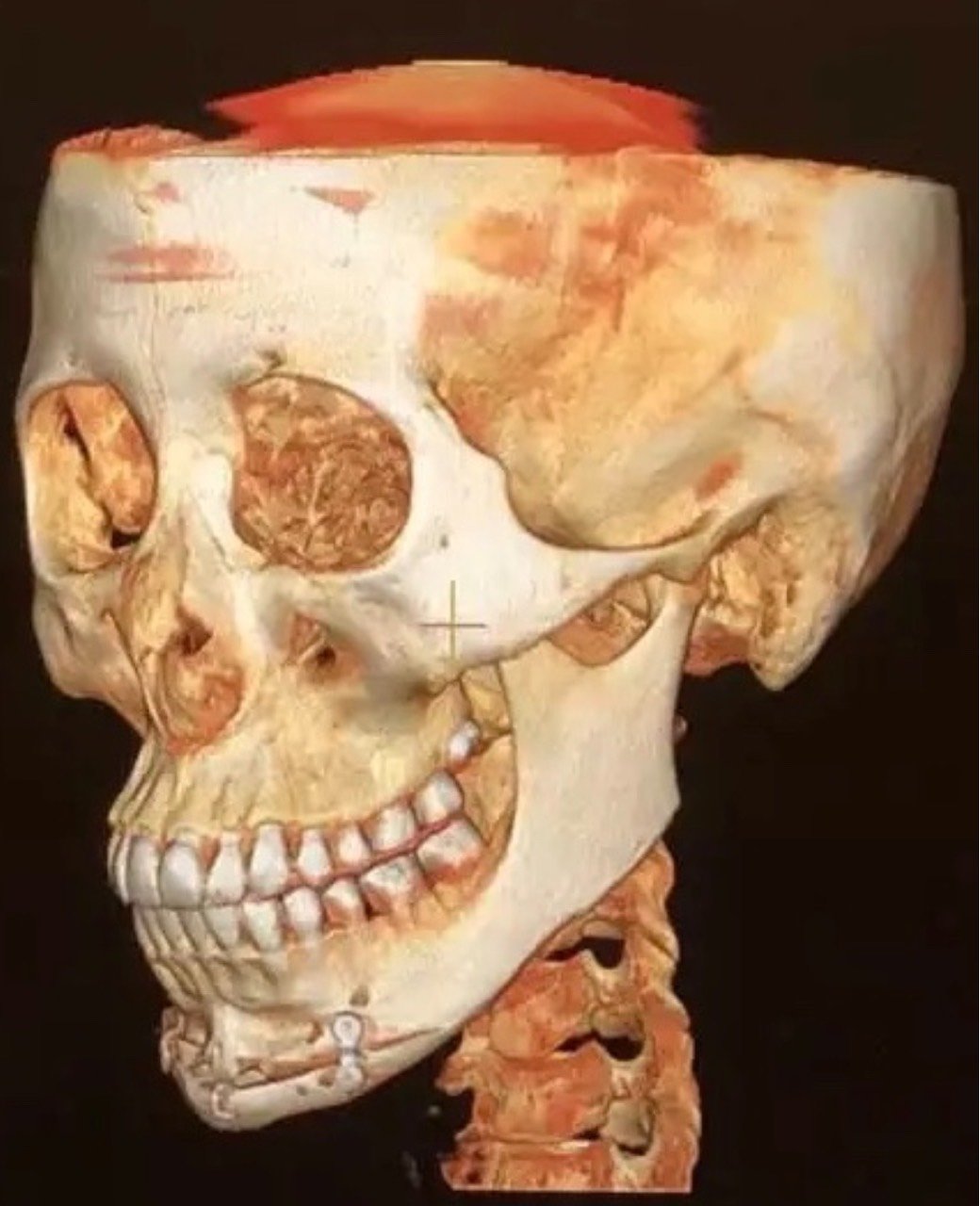 手术项目: 1 下颌角 下巴截骨前移 2 面吸 取
