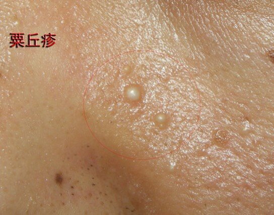 粟丘疹其实会自己掉,只是不会_圈子-新氧美容整形