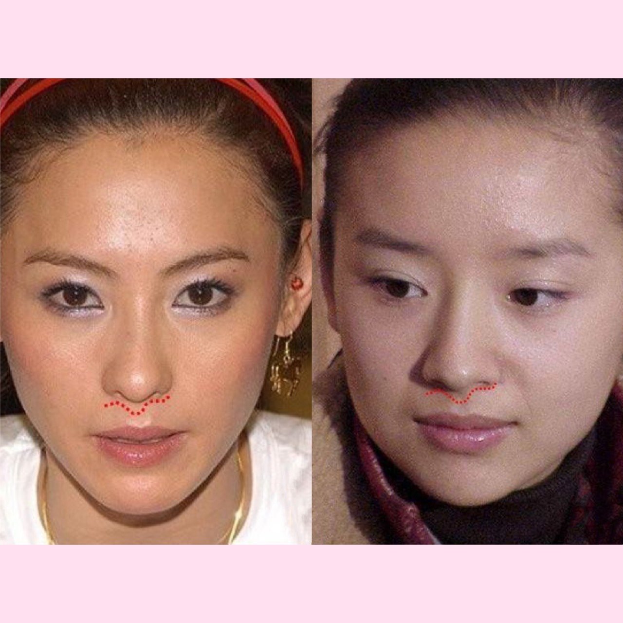 整了鼻子正面还是露鼻孔原来问题出在了这里.