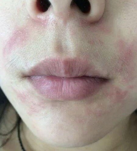 嘴巴周围又痛又痒是口周炎?如何预防和治疗?