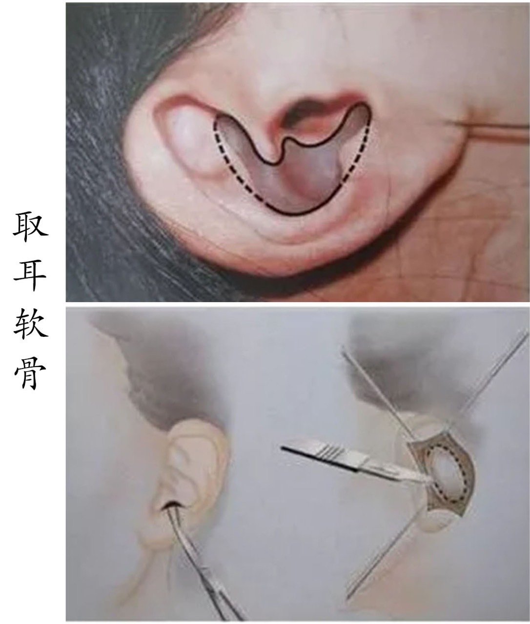 ⏰为什么我会选择在耳前取耳软骨? ·🌙💃很多求美者_圈子-新氧