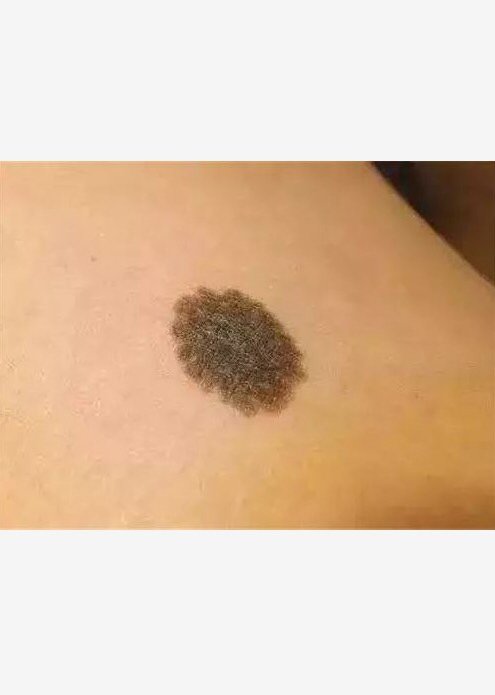 皮肤上有这个怎么去除