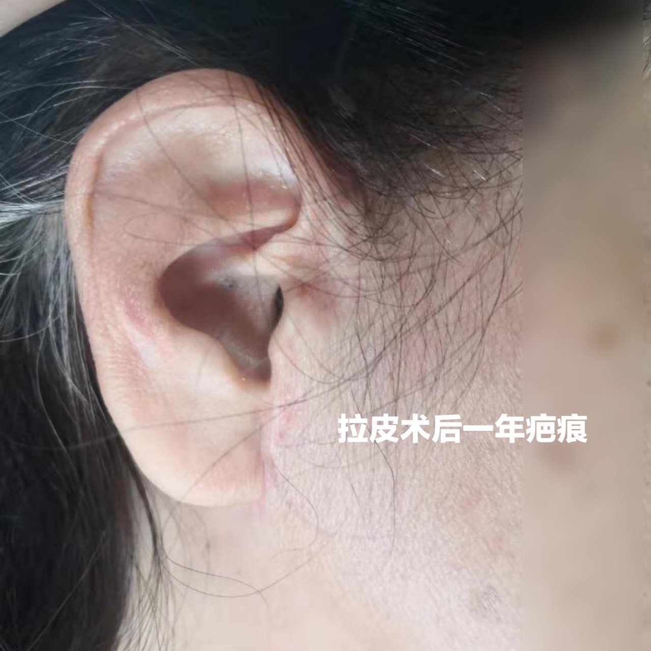 面部拉皮手术瘢痕到底重不重?