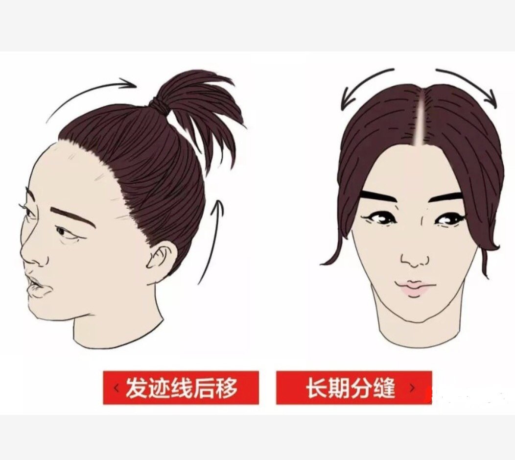 女生发际线后移怎么办