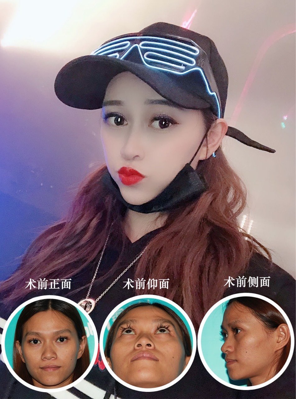 精致感杀手——鼻翼外扩,宽大该如何解决?