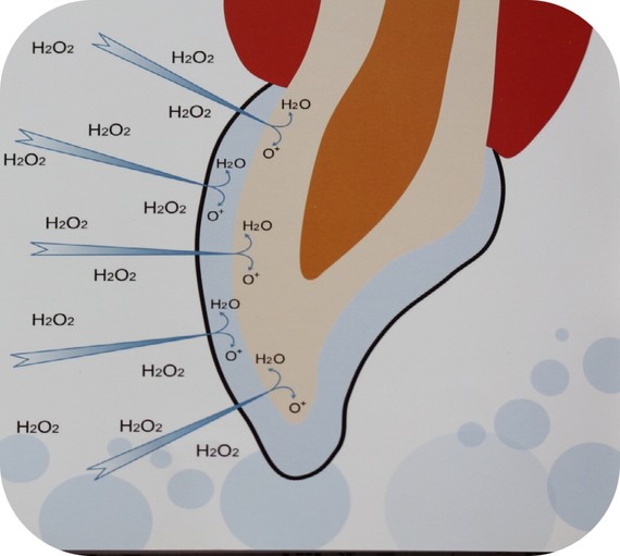 牙齿美白到底伤不伤牙通过吸附和渗透的原理,h2o2_圈子-新氧美容整形
