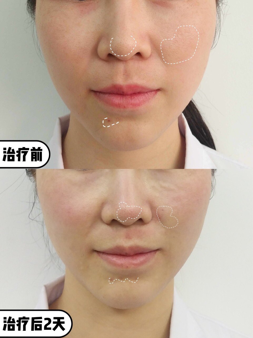 微针=童颜术,效果真的有那么好