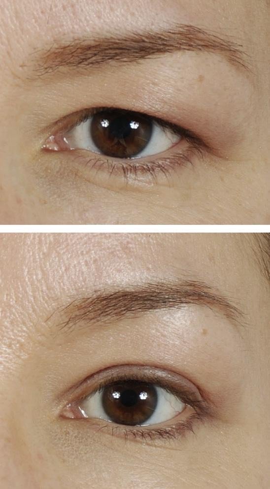 什么是上眼睑皮肤松弛手术方案有哪些