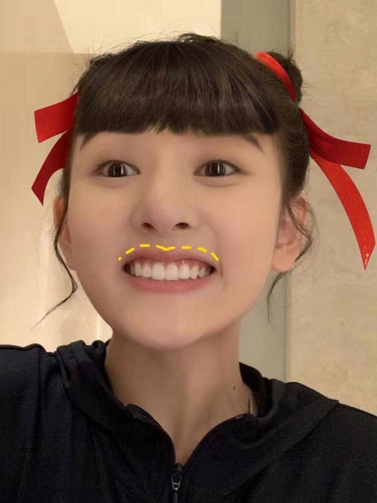 笑容受到笑线和微笑弧两种因素的影响.
