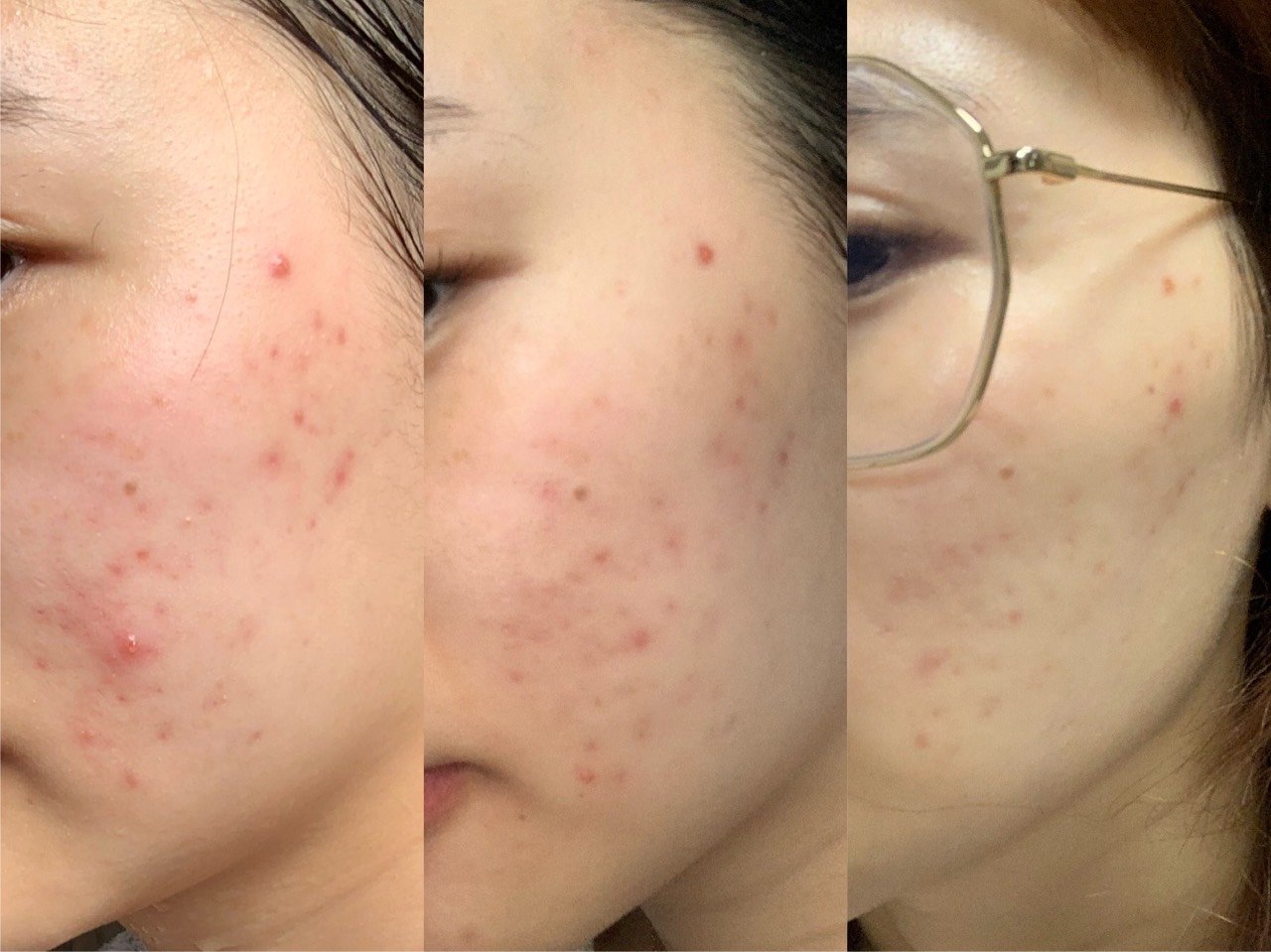 激光祛痘坑,让你的"月球表面脸"重获新生