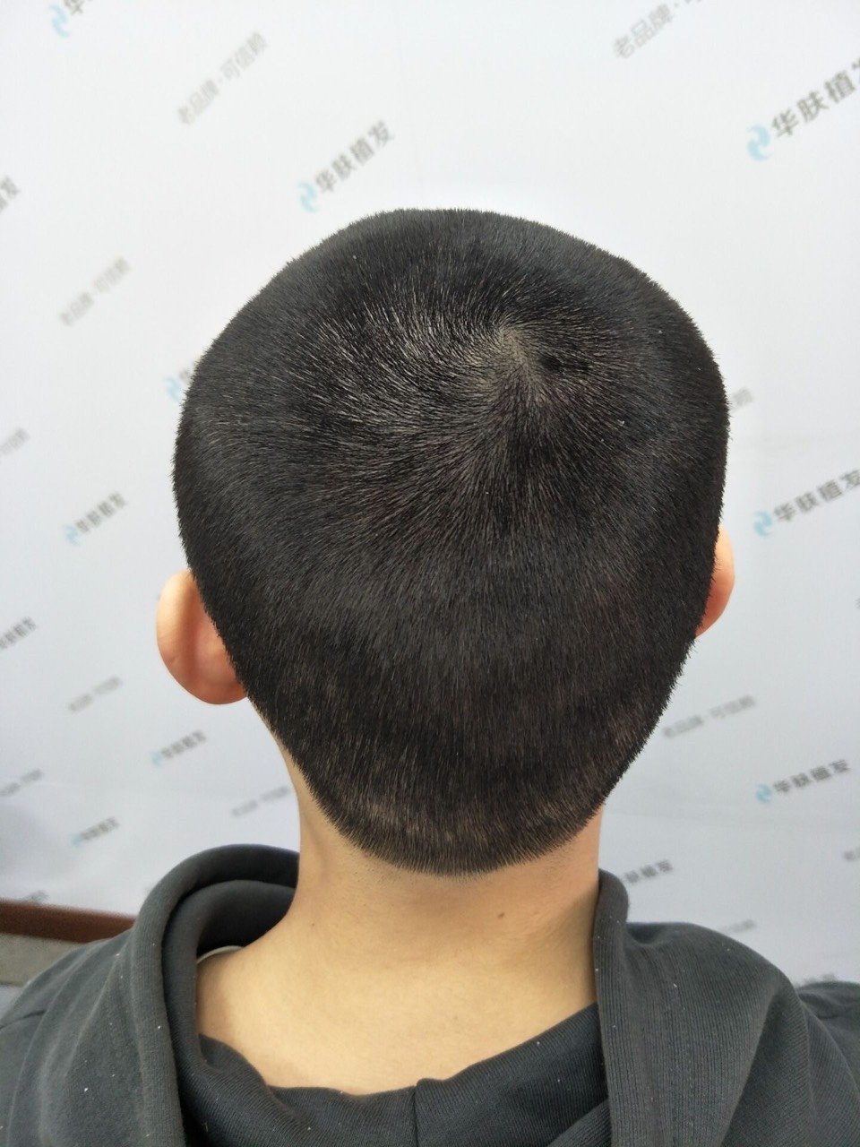 【植发会不会影响后枕部美观?】